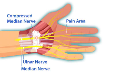 Is surgery the only option for Carpal Tunnel Syndrome?